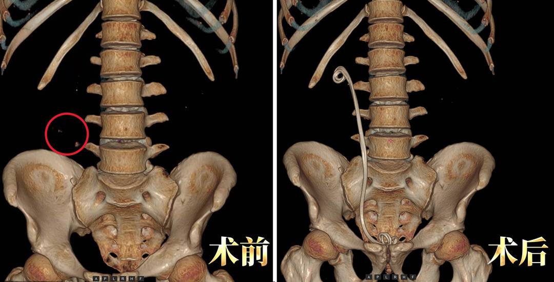 【媒体报道】一米八壮汉痛倒进急诊!这种病夏季高发,六成患者喝水少(图5) 【媒体报道】一米八壮汉痛倒进急诊!这种病夏季高发,六成患者喝水少(图5)