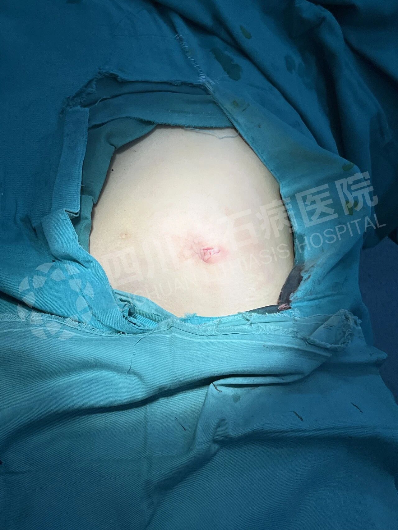 肚脐里做手术?15岁女孩的暑假“保胆记”【四川结石病医院】(图3) 肚脐里做手术?15岁女孩的暑假“保胆记”【四川结石病医院】(图3)