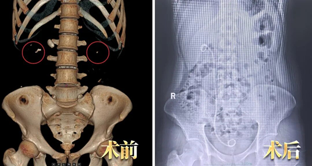 仅半年！结石发作“忍一忍”，一查肾脏差点“报废”？【四川结石病医院】(图2)