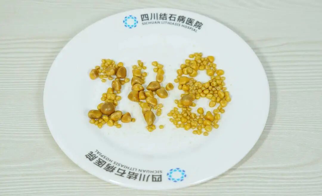 【媒体报道】26岁小伙保胆取出248颗结石，竟是因长期吃外卖(图2)