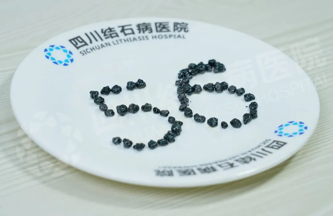胆结石拖到56颗，还能保胆吗？医生说得很直接【成都只有一家结石专科医院】(图1)