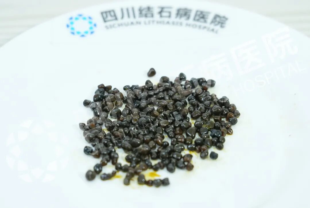 连夜抢救!医生痛心:查出这种病千万别拖【四川结石病医院,成都只有一家结石专科】(图1) 连夜抢救!医生痛心:查出这种病千万别拖【四川结石病医院,成都只有一家结石专科】(图1)